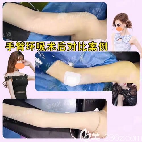 贛州葉子手臂吸脂前后對比圖
