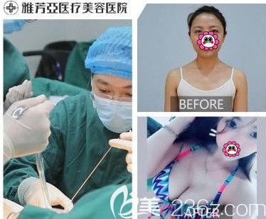雅芳亞整形醫(yī)院做隆胸案例