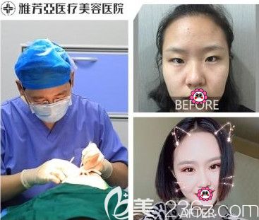 石家莊雅芳亞做雙眼皮前后對(duì)比圖