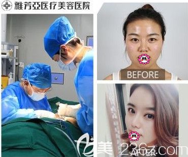 石家莊雅芳亞做隆鼻案例對(duì)比