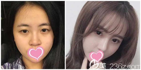 胡凱做假體隆鼻+肋軟骨隆鼻效果對比圖 胡凱做假體隆鼻+肋軟骨隆鼻效果對比圖