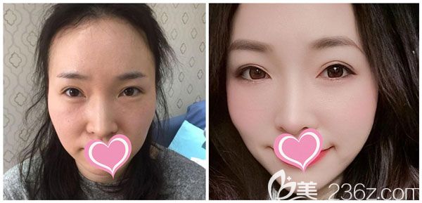 李成龍做面部線雕提升效果對比圖 李成龍做面部線雕提升效果對比圖