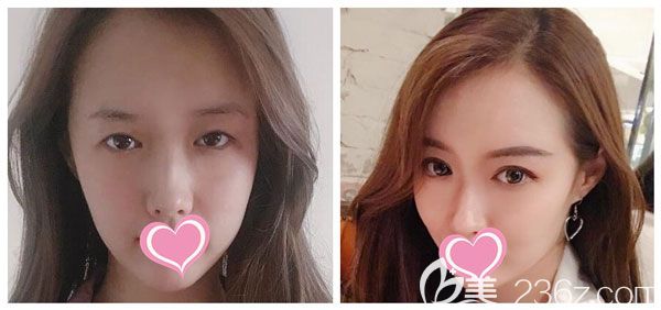 做眼綜合+全切雙眼皮效果對比圖 做眼綜合+全切雙眼皮效果對比圖