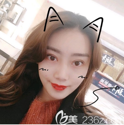 讓剛找田學(xué)勤做完眼綜合的我來(lái)告訴你汕頭華美割雙眼皮怎么樣吧