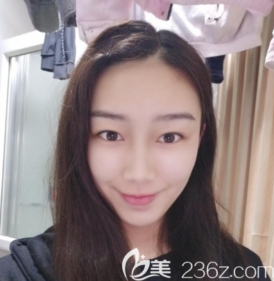 去汕頭華美做雙眼皮術(shù)前照片 去汕頭華美做雙眼皮術(shù)前照片