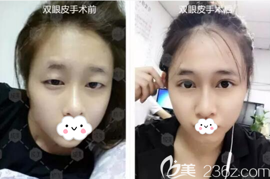 成都整形羅榮懷雙眼皮術(shù)前術(shù)后對(duì)比照片 成都整形羅榮懷雙眼皮術(shù)前術(shù)后對(duì)比照片