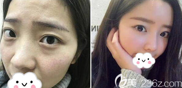 成美整形張莉線雕隆鼻術(shù)后效果 成美整形張莉線雕隆鼻術(shù)后效果