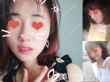 自體肋軟骨+假體鼻綜合術(shù)后15天<span style=