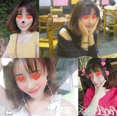 長沙美萊做鼻子怎么樣？用我做自體肋軟骨+假體鼻綜合術后30天恢復效果圖告訴你！