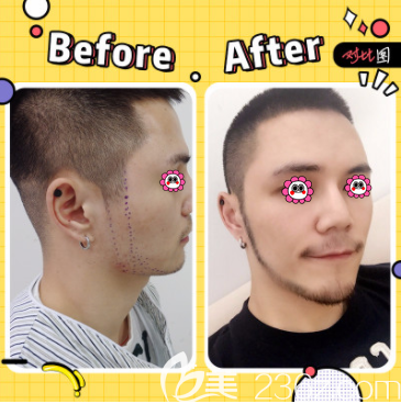 北京碧蓮盛魯少康醫(yī)生絡(luò)腮胡種植案例 北京碧蓮盛魯少康醫(yī)生絡(luò)腮胡種植案例