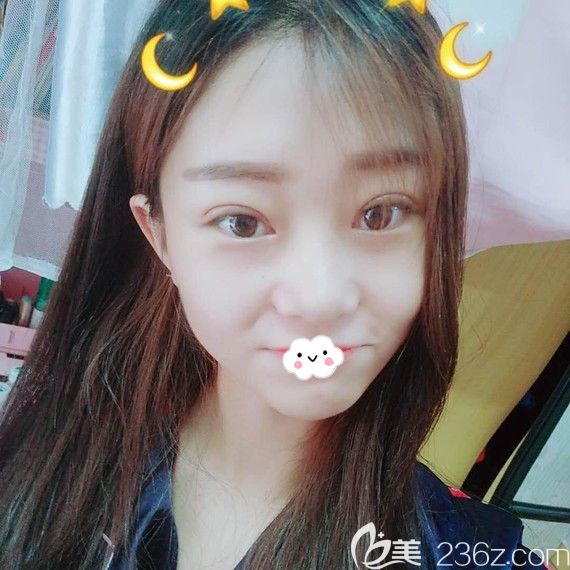 做夢也沒想到找湖北正規(guī)整形醫(yī)院黃石中愛萬文勇做雙眼皮開眼角后顏值暴漲