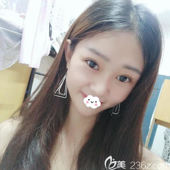 黃石中愛割雙眼皮怎么樣？萬文勇眼綜合案例