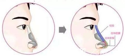 自體軟骨隆鼻和硅膠隆鼻那個(gè)更好？