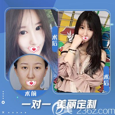 石家莊藍(lán)山整形醫(yī)院鼻綜合案例 石家莊藍(lán)山整形醫(yī)院鼻綜合案例