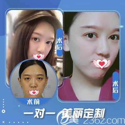 藍(lán)山整形醫(yī)院雙眼皮案例 藍(lán)山整形醫(yī)院雙眼皮案例