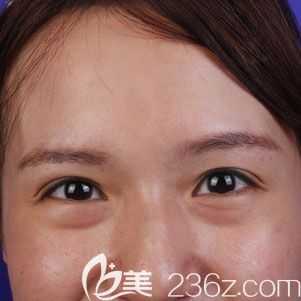 內切去眼袋術前照片 內切去眼袋術前照片