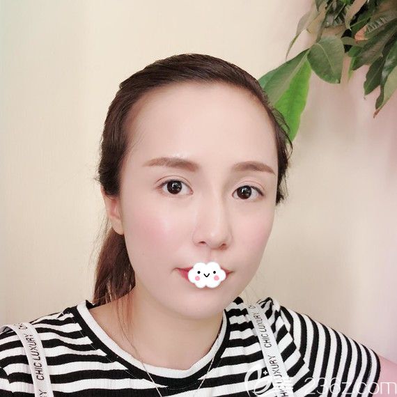 武漢萊美整形美容醫(yī)院祛眼袋術后恢復照片 武漢萊美整形美容醫(yī)院祛眼袋術后恢復照片