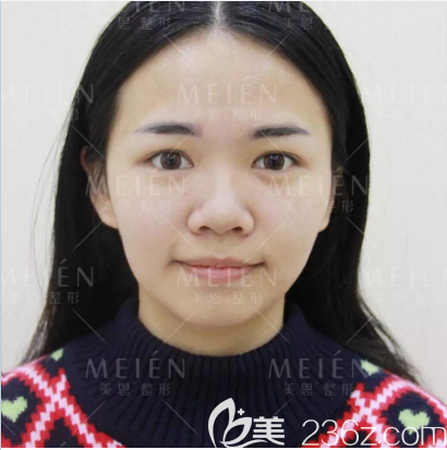 去廣州美恩隆鼻術(shù)前照片 去廣州美恩隆鼻術(shù)前照片