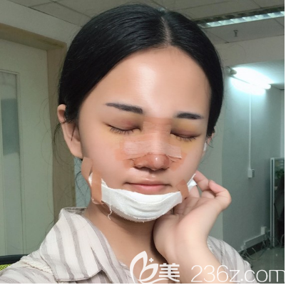 廣州美恩隆鼻+豐下巴術(shù)后三天 廣州美恩隆鼻+豐下巴術(shù)后三天