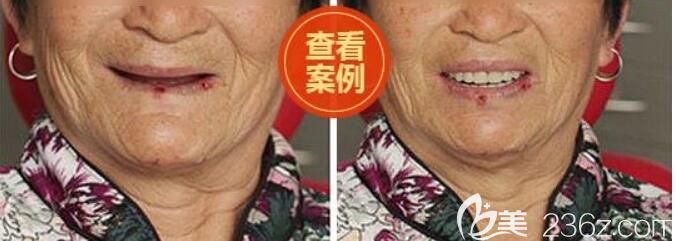 北京中諾口腔種植牙案例 北京中諾口腔種植牙案例