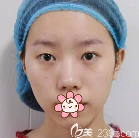 術(shù)前眼睛一單一雙不對稱 術(shù)前眼睛一單一雙不對稱