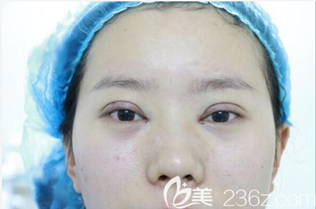 羅榮懷切開雙眼皮術(shù)后即刻 羅榮懷切開雙眼皮術(shù)后即刻
