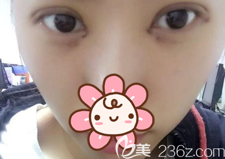 雙眼皮開眼角術(shù)后5天恢復(fù)情況 雙眼皮開眼角術(shù)后5天恢復(fù)情況