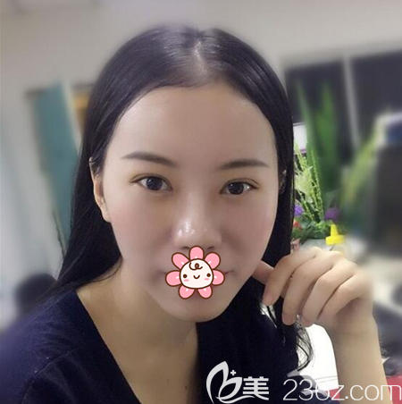 切開雙眼皮+開眼角術(shù)后一個與素顏照 切開雙眼皮+開眼角術(shù)后一個與素顏照