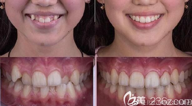 北京中諾口腔陳美占牙齒矯正案例