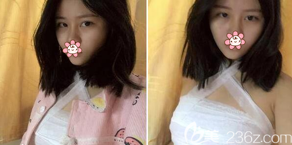 假體豐胸術(shù)后即刻效果