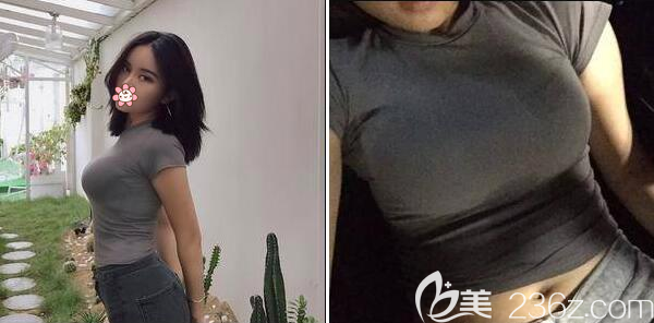 賴明忠豐胸手術(shù)術(shù)后一個月恢復(fù)效果