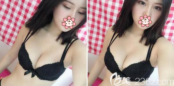 假體豐胸術(shù)后3個月內(nèi)衣照