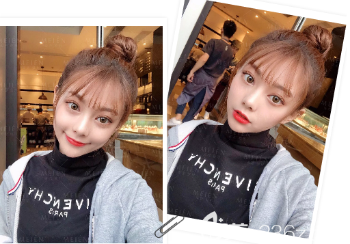 廣州美恩陳宏彬脂肪填充案例圖片 廣州美恩陳宏彬脂肪填充案例圖片