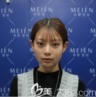 在廣州美恩做脂肪填充術(shù)前照片 在廣州美恩做脂肪填充術(shù)前照片