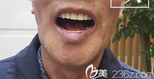 65歲詹大爺在北京中諾口腔做全口種植牙全過程直播 并反饋種植牙后感受