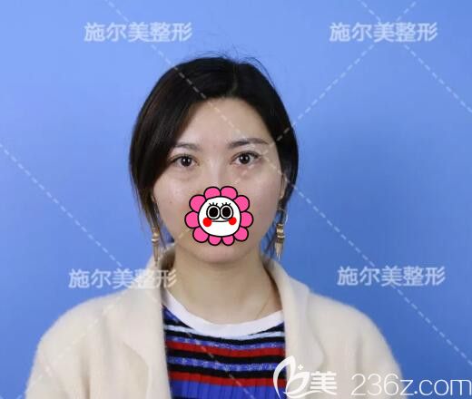 面診江蘇施爾美術(shù)前眼袋明顯 面診江蘇施爾美術(shù)前眼袋明顯