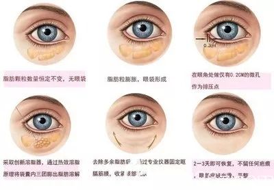 醫(yī)美整形去眼袋手術(shù)方法原理 醫(yī)美整形去眼袋手術(shù)方法原理