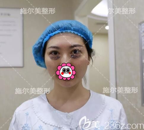 孫欣主任術(shù)前劃線設(shè)計(jì)去眼袋 孫欣主任術(shù)前劃線設(shè)計(jì)去眼袋