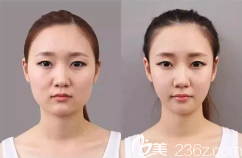 貴陽(yáng)美萊瘦臉案例