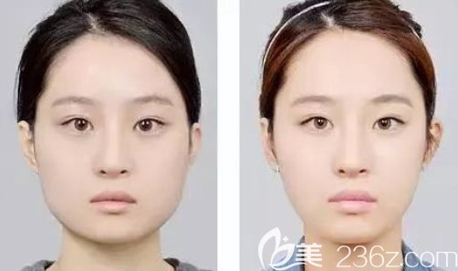 貴陽(yáng)美萊瘦臉效果怎么樣