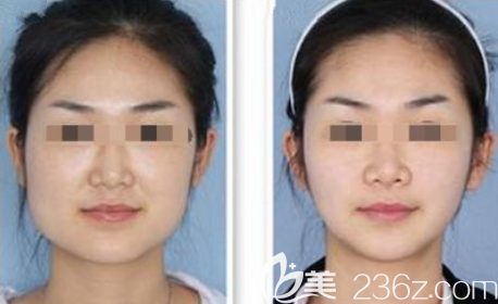 貴陽(yáng)美萊打瘦臉效果好不好