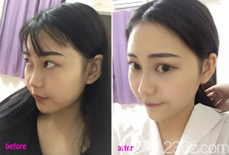 貴陽(yáng)美萊瘦臉案例