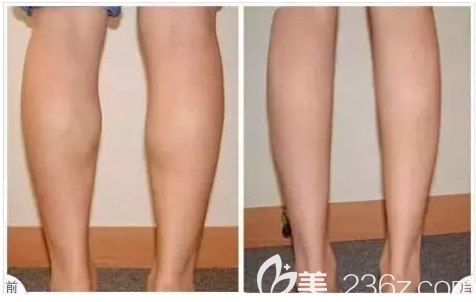 貴陽(yáng)美萊瘦腿案例