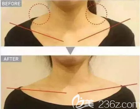 瘦肩效果對(duì)比