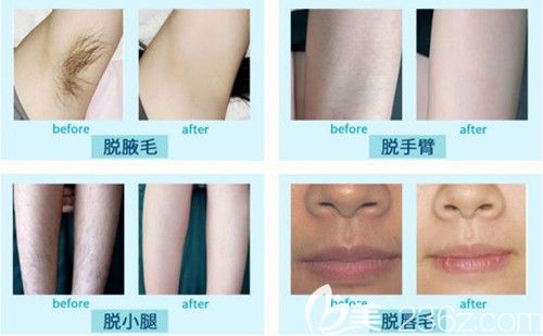 沈陽百嘉麗整形脫毛真人前后效果對比