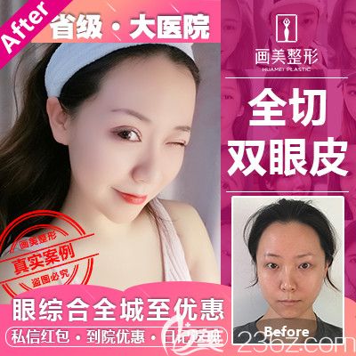 廣東畫美牟北平雙眼皮眼綜合<span style= 廣東畫美牟北平雙眼皮眼綜合<span style=