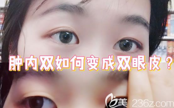 東陽橫店麗萊整形割雙眼皮怎么樣?整理一份麗萊雙眼皮隆鼻價格及案例效果圖