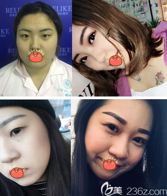 東陽橫店麗萊割雙眼皮案例 東陽橫店麗萊割雙眼皮案例
