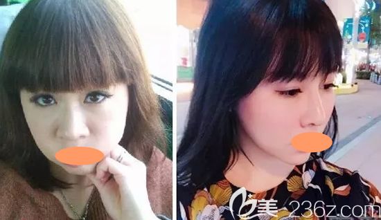 景德鎮(zhèn)圣嘉麗整形劉院長鼻綜合整形案例效果圖