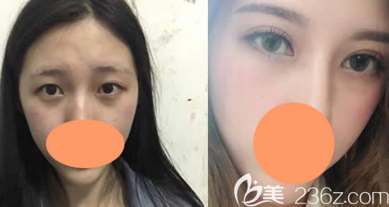 景德鎮(zhèn)圣嘉麗整形劉院長雙眼皮整形效果對比圖